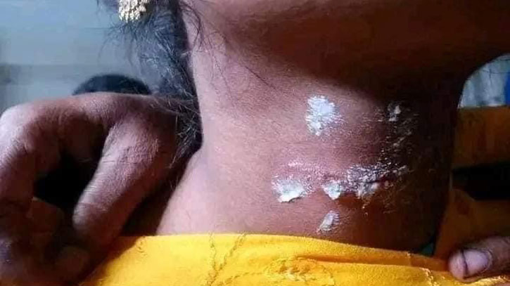 নোয়াখালীতে বিদ্যালয় থেকে ফেরার পথে স্কুলছাত্রীকে গলা কেটে হত্যার চেষ্টা নোয়াখালীতে বিদ্যালয় থেকে ফেরার পথে স্কুলছাত্রীকে গলা কেটে হত্যার চেষ্টা