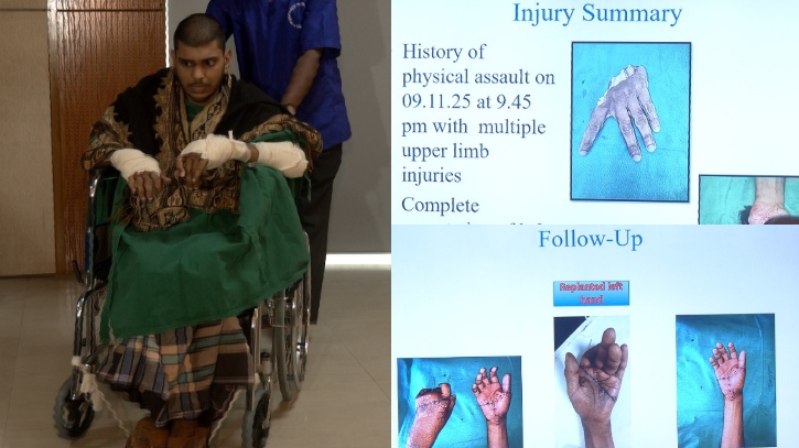 কুড়িয়ে আনা বিচ্ছিন্ন হাত জোড়া লাগিয়ে ইতিহাস গড়লো জাতীয় বার্ন ও প্লাস্টিক সার্জারি ইনস্টিটিউট