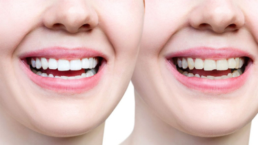 ‘ভাঙা দাঁতের খোঁচা থেকেও হতে পারে মরণব্যাধি ক্যান্সার’