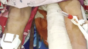 জ্ঞান ফেরার পর রোগীর আর্তনাদ, ভাঙা পা রেখে সুস্থ পায়েই অস্ত্রোপচার