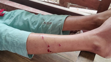 ক্ষেপা কুকুরের কামড়ে ঈদের দিন মুহূর্তেই রক্তাক্ত হলো ১৬ জন ক্ষেপা কুকুরের কামড়ে ঈদের দিন মুহূর্তেই রক্তাক্ত হলো ১৬ জন