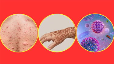 জেলায় জেলায় আশঙ্কাজনক হারে বাড়ছে হামে আক্রান্ত শিশুর সংখ্যা