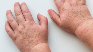 শিশুকে কখন দিতে হবে হামের প্রথম টিকা ও বুস্টার ডোজ? 