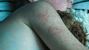 যেসব সচেতনতায় হাম থেকে বাঁচতে পারে আপনার শিশু